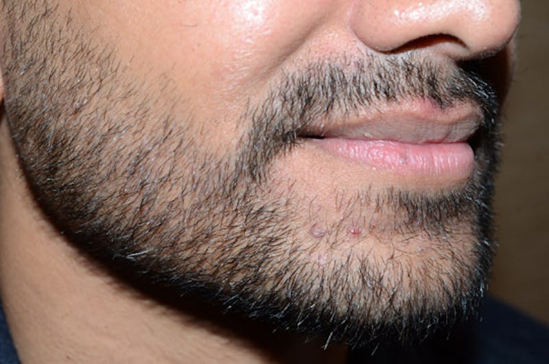 Facial Hair Transplant Before & After Gallery - Patient 260698 - Image 6