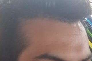 Hairline Lowering Surgery Before & After Gallery - Patient 831037 - Image 6