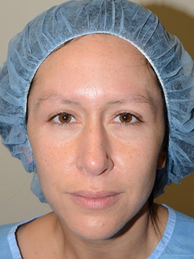 Eyebrow Transplantation Before & After Gallery - Patient 292573 - Image 1