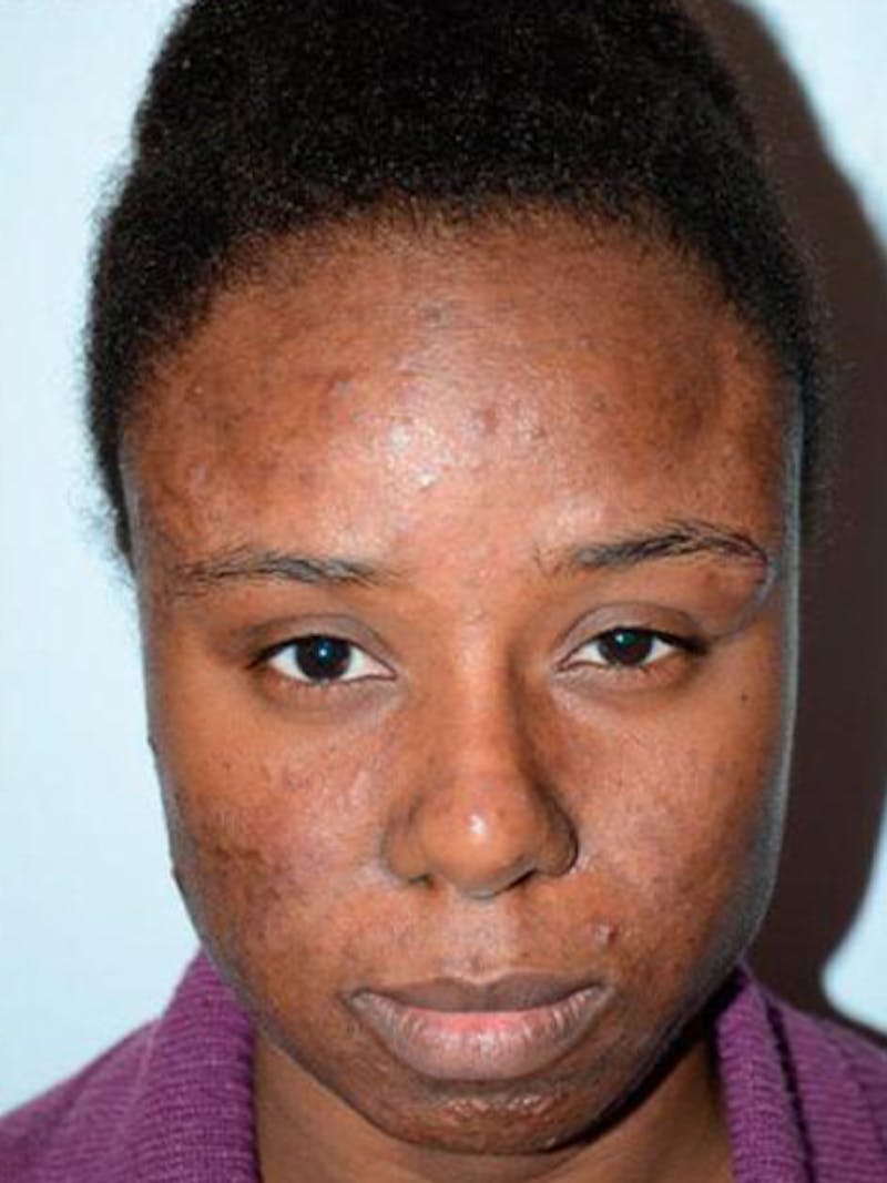 Hair Procedures for Women Before & After Gallery - Patient 369952 - Image 2
