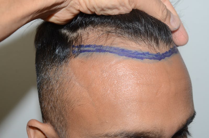 Hair Restoration for Men Before & After Gallery - Patient 143607 - Image 5