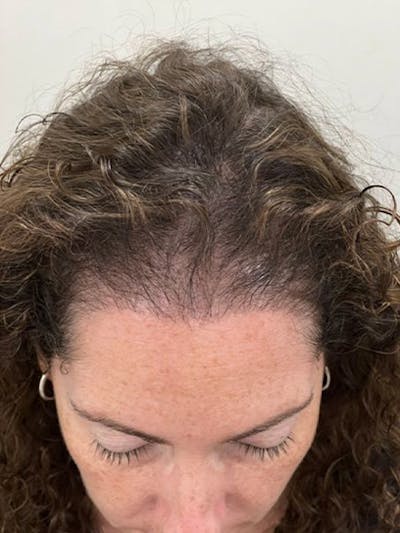 SMP Procedures Before & After Gallery - Patient 339842 - Image 2
