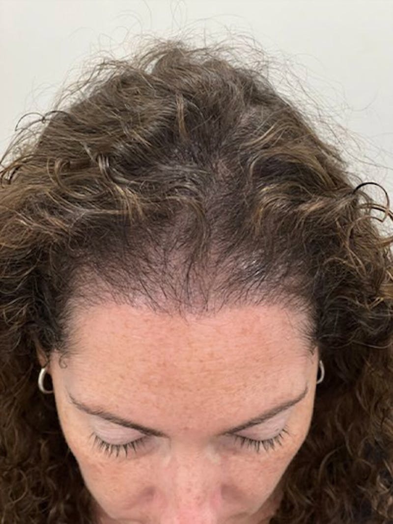 Scalp Micropigmentation Procedures Before & After Gallery - Patient 369227 - Image 2