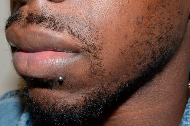 Facial Hair Transplant Before & After Gallery - Patient 680870 - Image 1