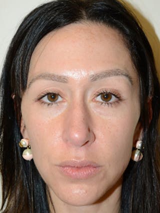 Eyebrow Transplantation Before & After Gallery - Patient 295621 - Image 2