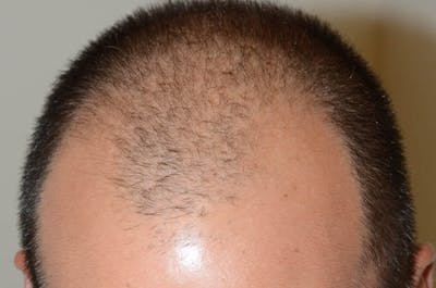 Hair Restoration for Men Before & After Gallery - Patient 551230 - Image 1