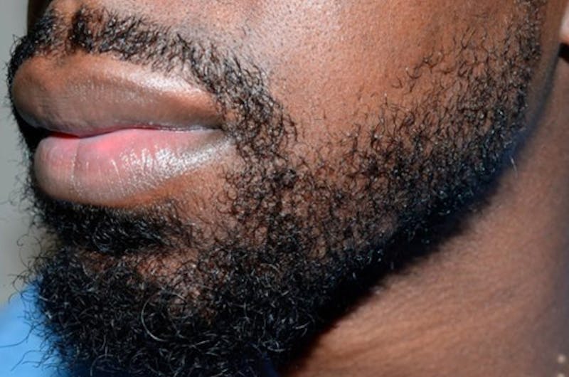 Facial Hair Transplant Before & After Gallery - Patient 680870 - Image 2