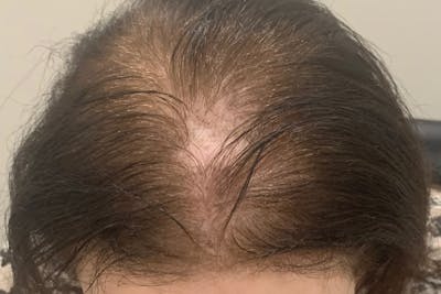SMP Procedures Before & After Gallery - Patient 262614 - Image 1