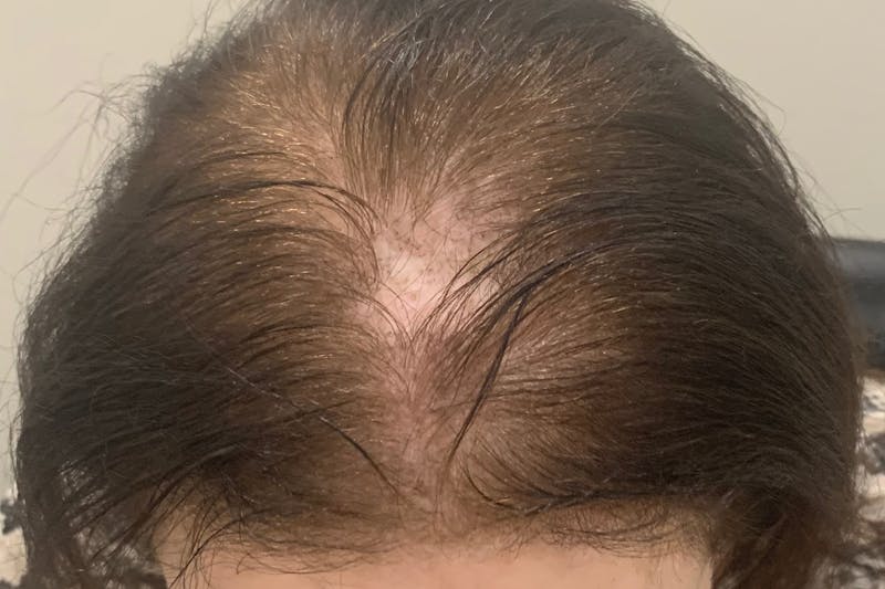 Scalp Micropigmentation Procedures Before & After Gallery - Patient 198293 - Image 1