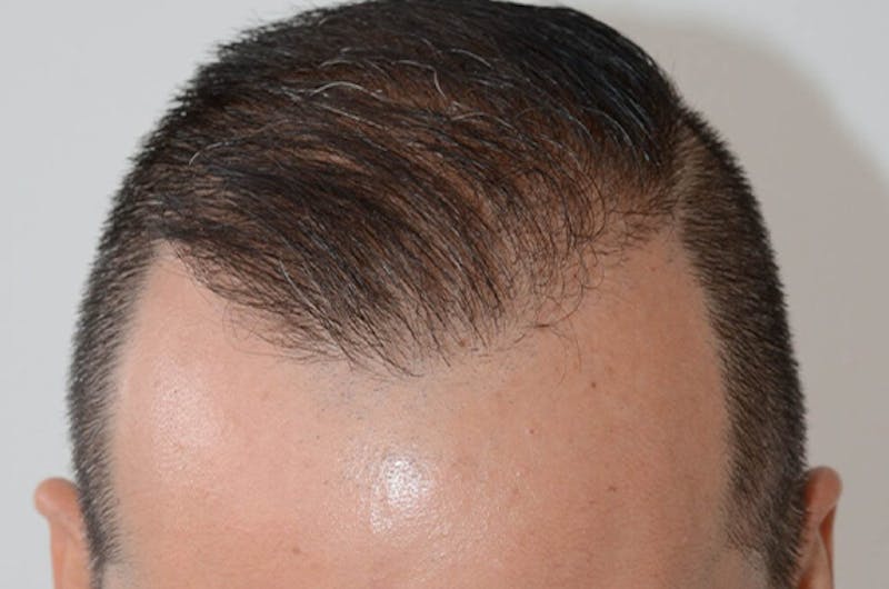 Hair Restoration for Men Before & After Gallery - Patient 320717 - Image 2