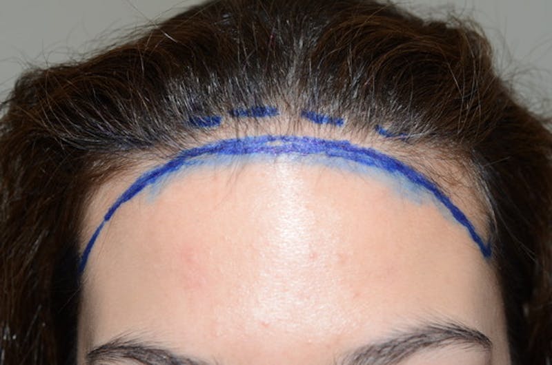 Hair Procedures for Women Before & After Gallery - Patient 114804 - Image 1