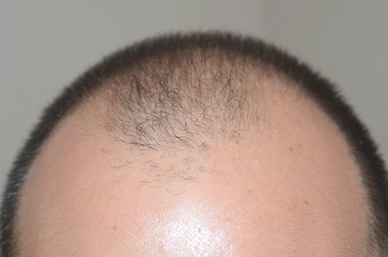 Hair Restoration for Men Before & After Gallery - Patient 320717 - Image 3