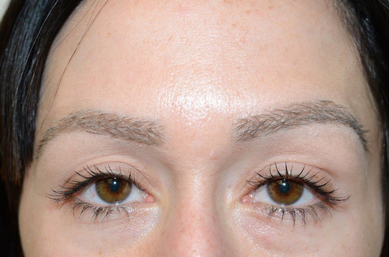 Eyebrow Transplantation Before & After Gallery - Patient 292573 - Image 4