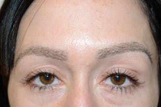Eyebrow Transplantation Before & After Gallery - Patient 295621 - Image 4