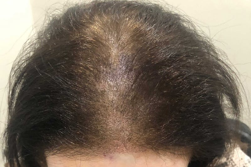Scalp Micropigmentation Procedures Before & After Gallery - Patient 198293 - Image 2