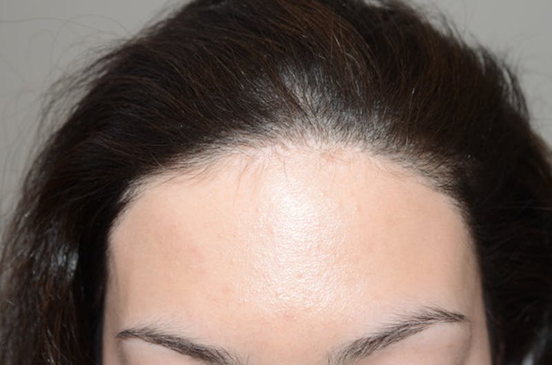 Hair Procedures for Women Before & After Gallery - Patient 114804 - Image 2