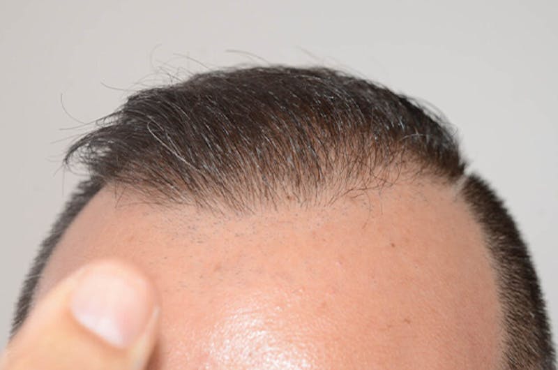 Hair Restoration for Men Before & After Gallery - Patient 320717 - Image 4