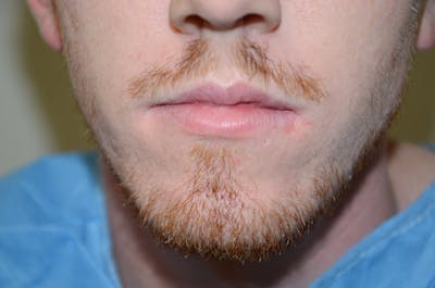 Facial Hair Transplant Before & After Gallery - Patient 226655 - Image 1
