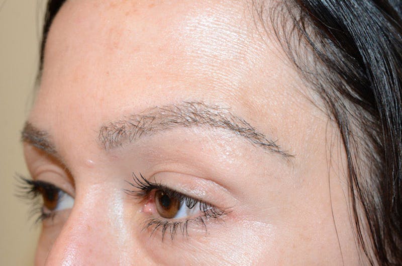 Eyebrow Transplantation Before & After Gallery - Patient 292573 - Image 6