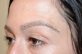Eyebrow Transplantation Before & After Gallery - Patient 295621 - Image 6