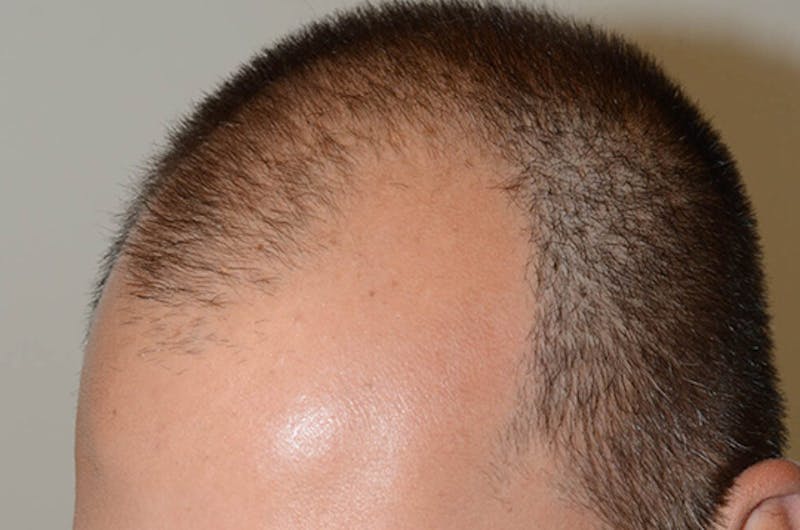 Hair Restoration for Men Before & After Gallery - Patient 320717 - Image 5