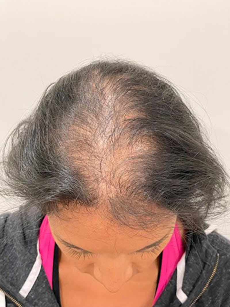 Scalp Micropigmentation Procedures Before & After Gallery - Patient 250302 - Image 1