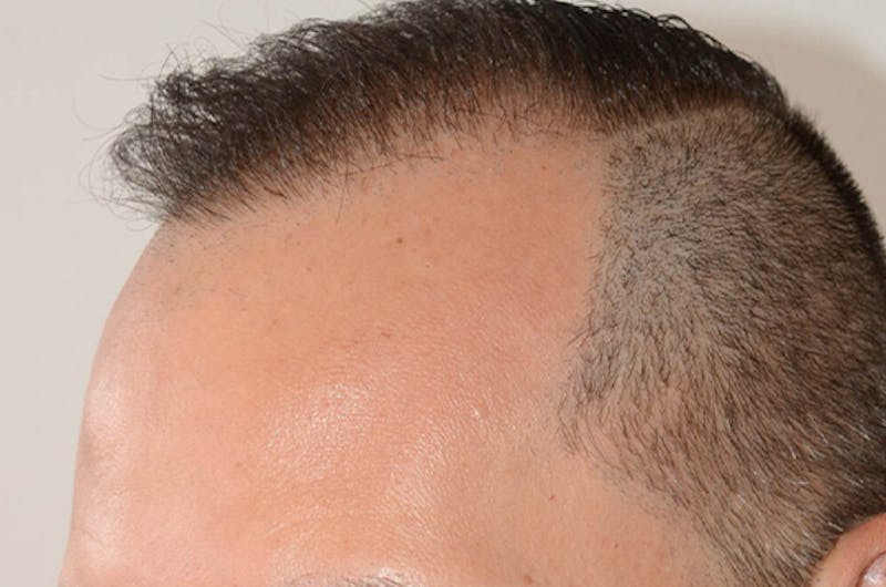 Hair Restoration for Men Before & After Gallery - Patient 320717 - Image 6