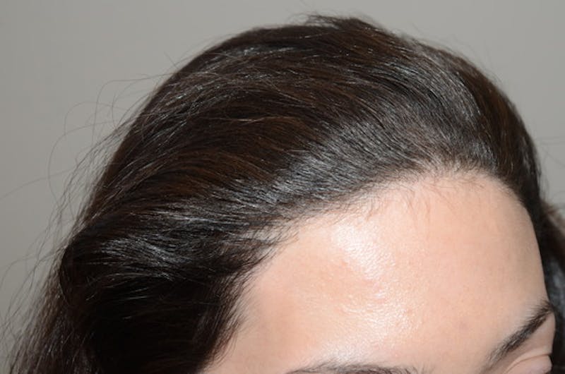Hair Procedures for Women Before & After Gallery - Patient 114804 - Image 4