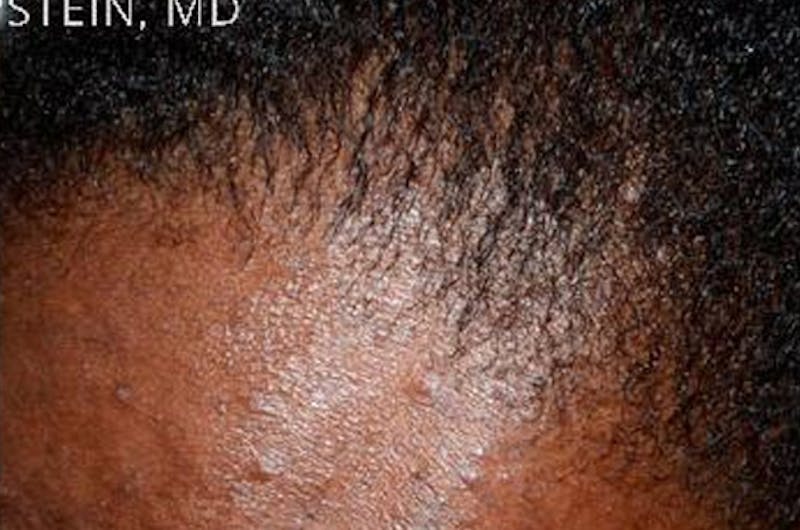 Hair Procedures for Women Before & After Gallery - Patient 369952 - Image 8