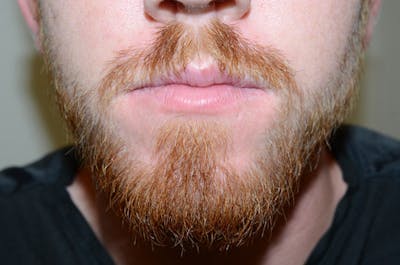 Facial Hair Transplant Before & After Gallery - Patient 226655 - Image 2