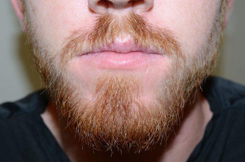 Facial Hair Transplant Before & After Gallery - Patient 428627 - Image 2