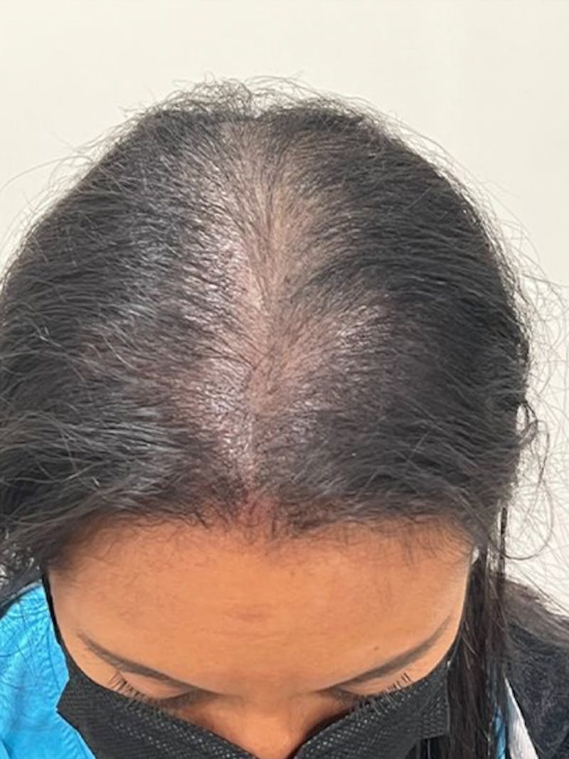 Scalp Micropigmentation Procedures Before & After Gallery - Patient 250302 - Image 2