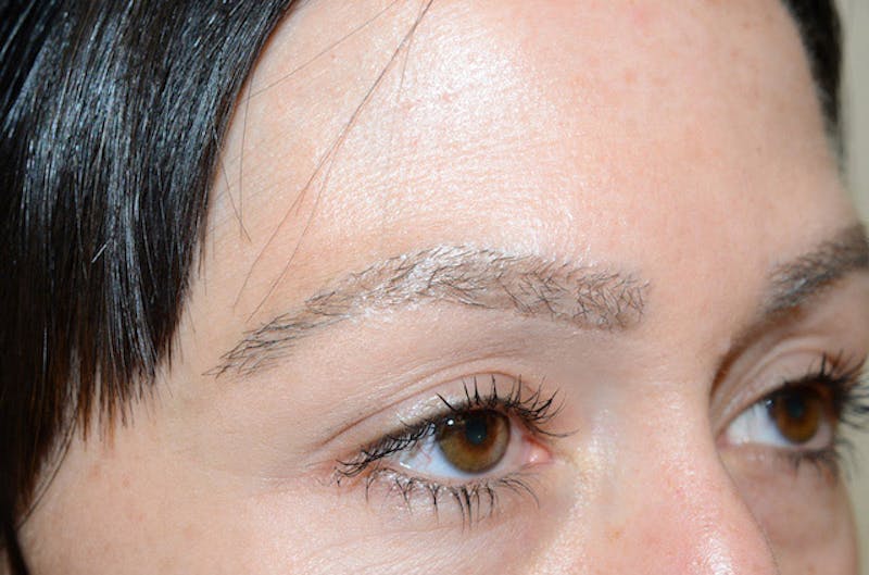 Eyebrow Transplantation Before & After Gallery - Patient 292573 - Image 8