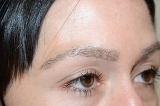 Eyebrow Transplantation Before & After Gallery - Patient 295621 - Image 8
