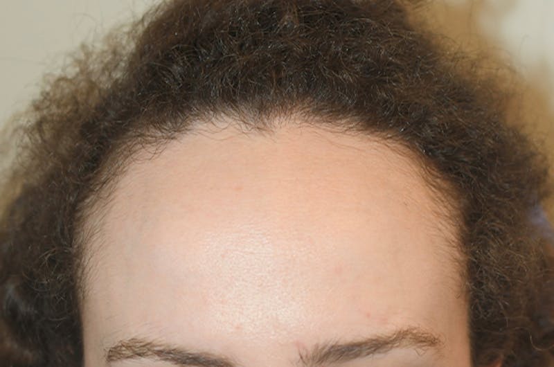 Hairline Lowering Surgery Before & After Gallery - Patient 374805 - Image 1