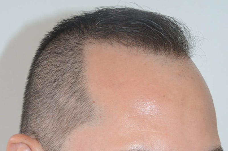 Hair Restoration for Men Before & After Gallery - Patient 320717 - Image 8