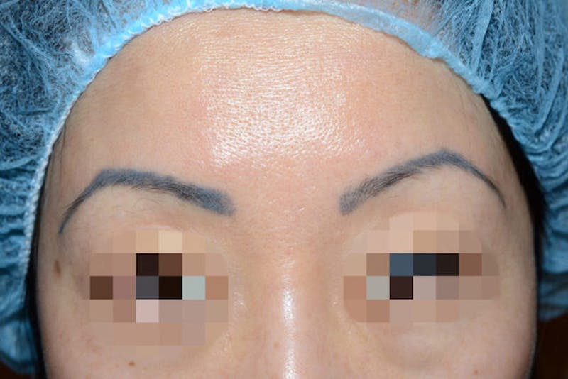 Eyebrow Transplantation Before & After Gallery - Patient 340196 - Image 1