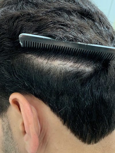 SMP Procedures Before & After Gallery - Patient 299181 - Image 1