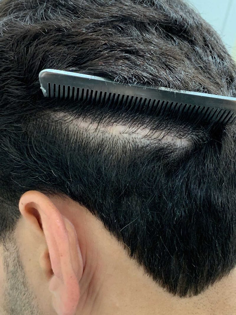 Scalp Micropigmentation Procedures Before & After Gallery - Patient 963696 - Image 1