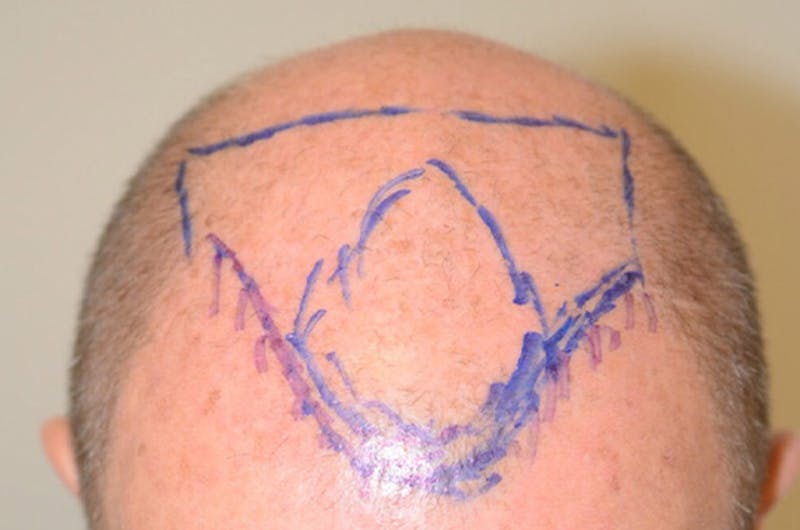 Hair Transplant Repair Before & After Gallery - Patient 206162 - Image 1