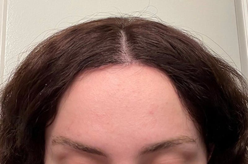 Hairline Lowering Surgery Before & After Gallery - Patient 374805 - Image 2
