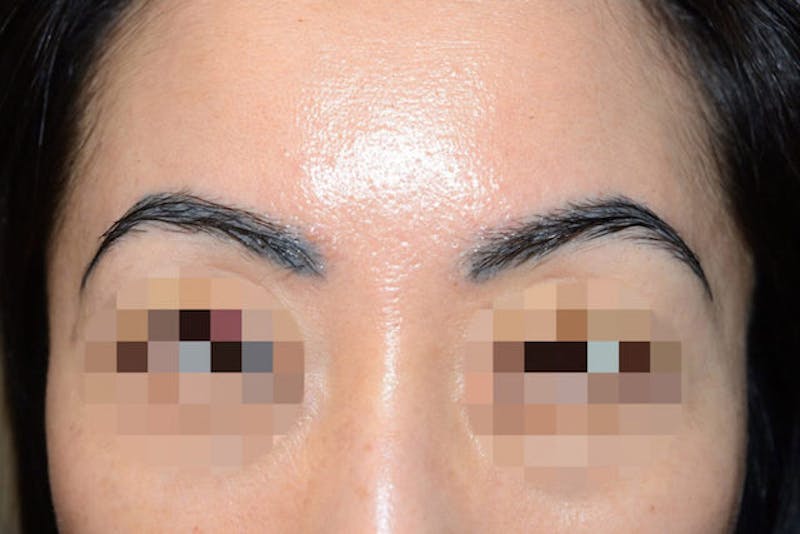 Eyebrow Transplantation Before & After Gallery - Patient 340196 - Image 2