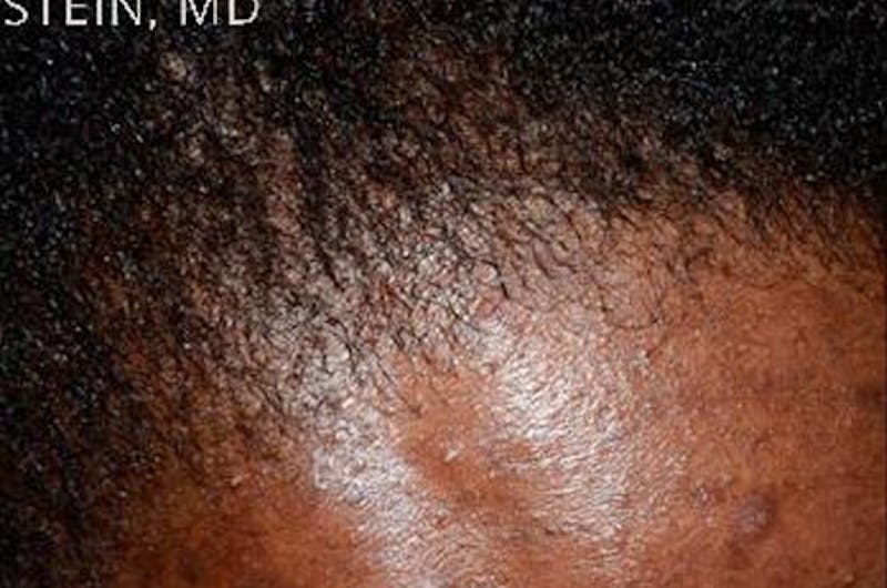 Hair Procedures for Women Before & After Gallery - Patient 369952 - Image 10