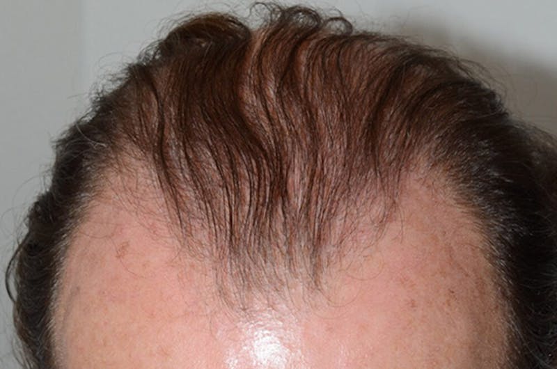 Hair Transplant Repair Before & After Gallery - Patient 206162 - Image 2