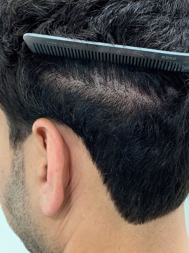 Scalp Micropigmentation Procedures Before & After Gallery - Patient 963696 - Image 2