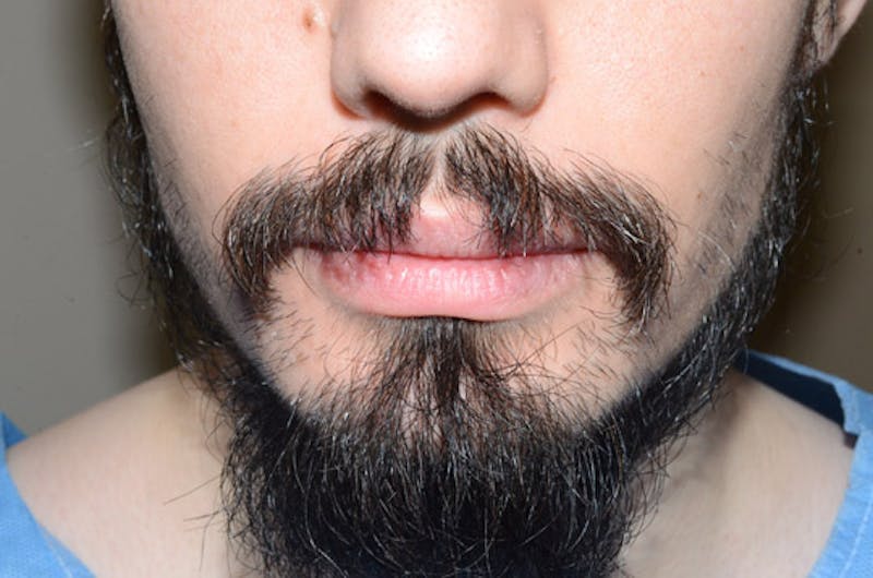 Facial Hair Transplant Before & After Gallery - Patient 977017 - Image 1