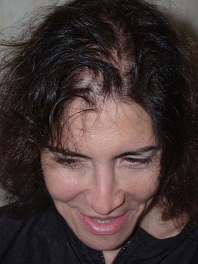 Hair Procedures for Women Before & After Gallery - Patient 199945 - Image 1