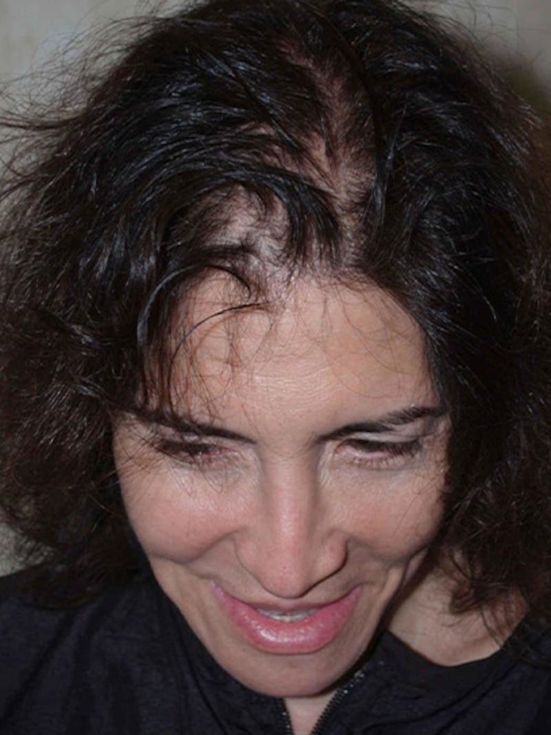 Hair Procedures for Women Before & After Gallery - Patient 403118 - Image 1