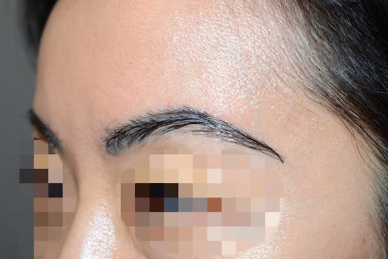 Eyebrow Transplantation Before & After Gallery - Patient 340196 - Image 4