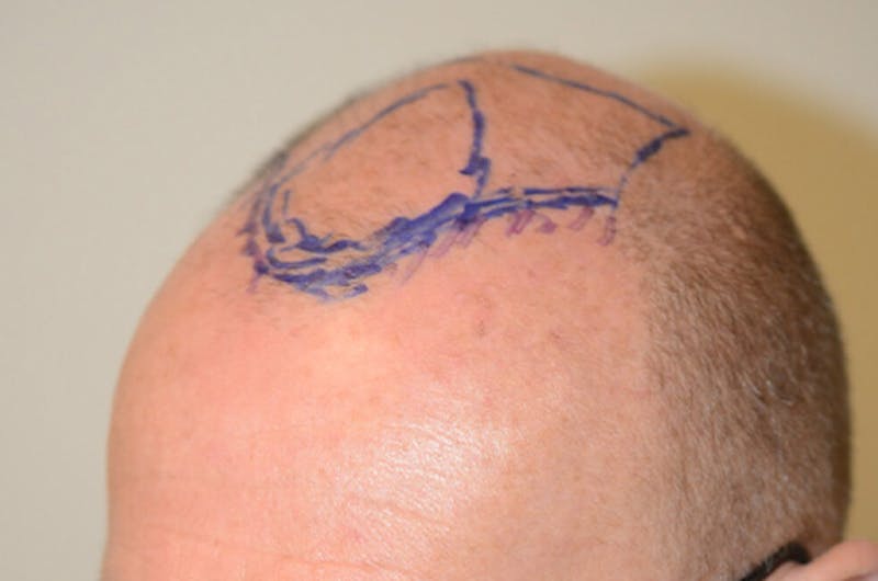 Hair Transplant Repair Before & After Gallery - Patient 206162 - Image 3